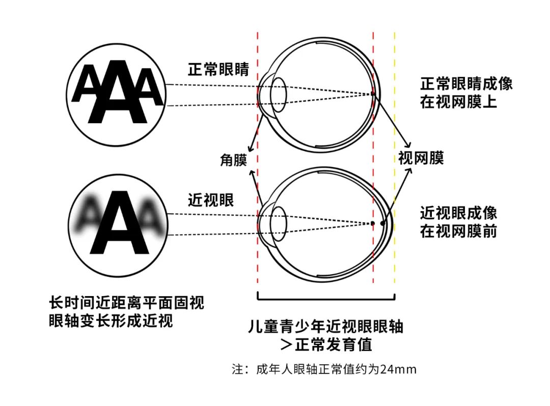 近视防控必读 | 眼轴到底是什么？
